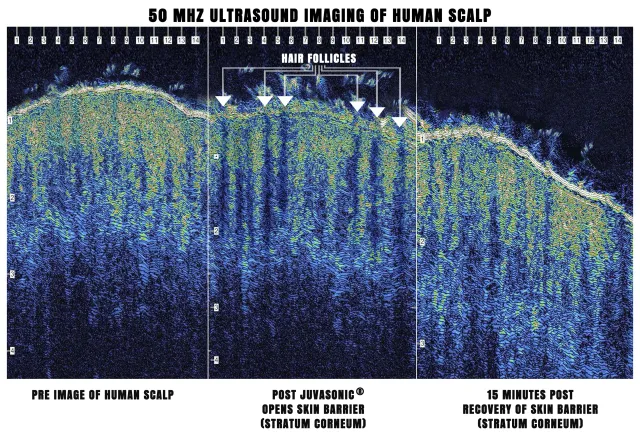 50 MHz ultrasound imaging of human scalp showing skin barrier before, during, and after ultrasound-assisted delivery